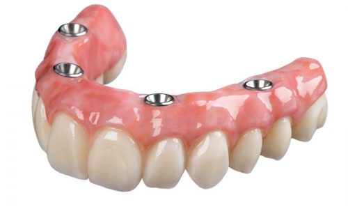All-on-4-dental-implant