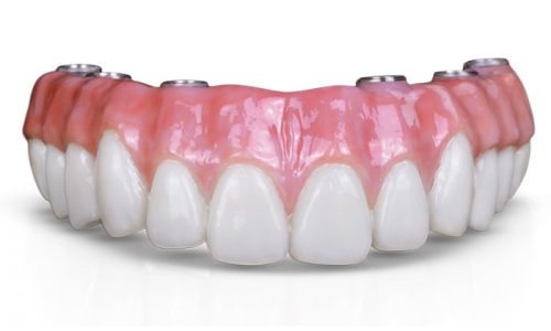 All-on-6-dental-implant